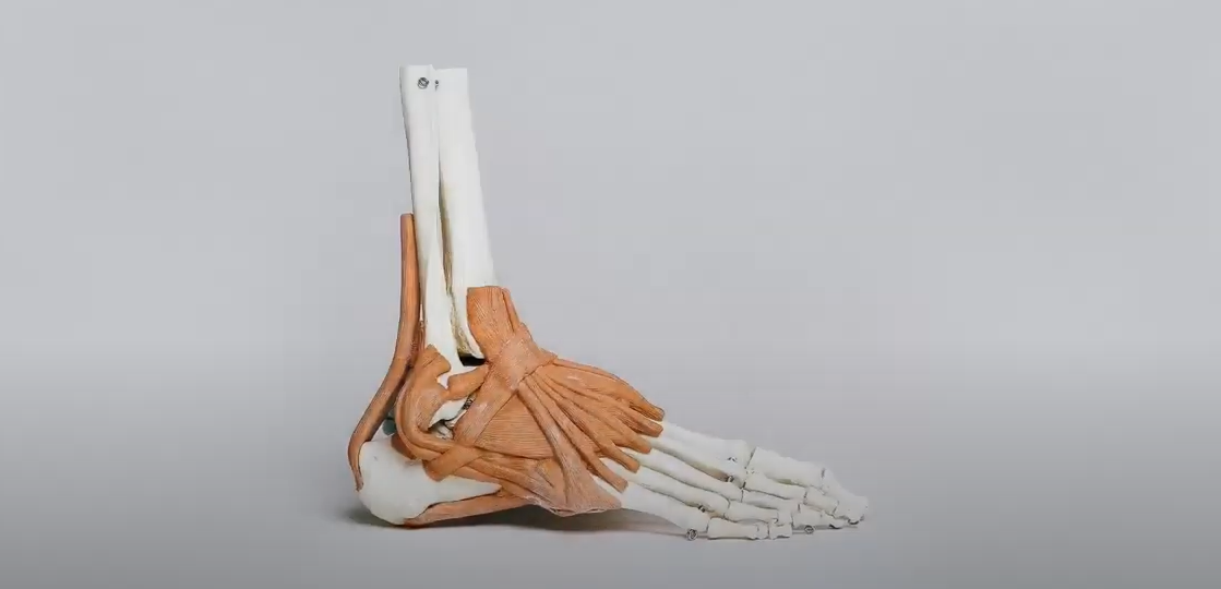plantar fasciitis